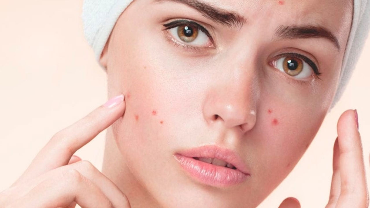 antalya akne tedavisi