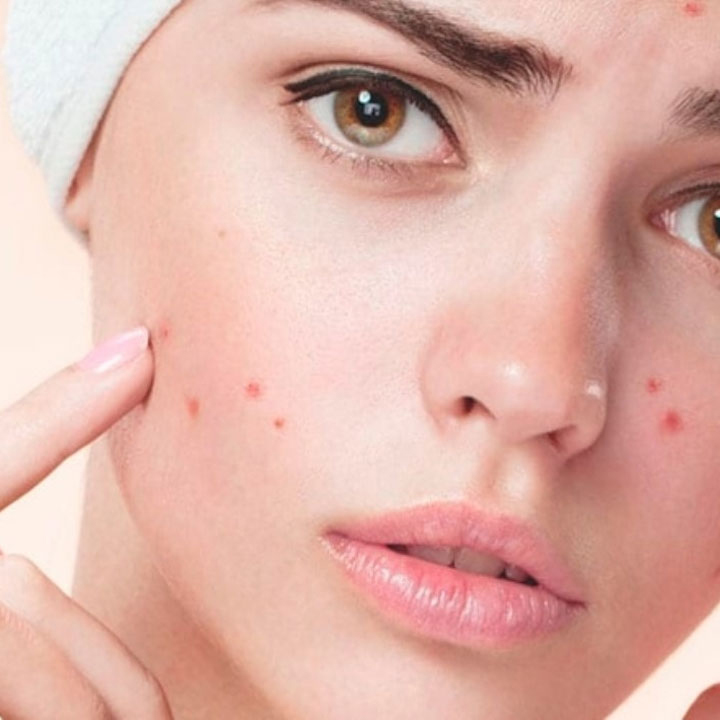 antalya akne tedavisi